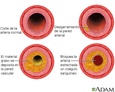 Proceso de evolución de la aterosclerosis