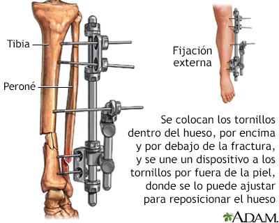 Dispositivo de fijación externa