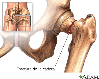 Fractura de cadera