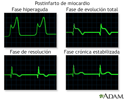 Gráficos de las ondas del ECG después del infarto al miocardio