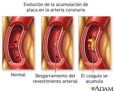 Acumulación progresiva de placa en arteria coronaria