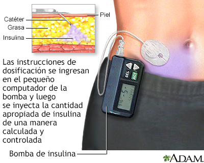 Bomba de insulina