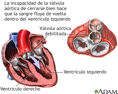 Insuficiencia aórtica