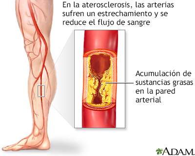 Arteriosclerosis de las extremidades