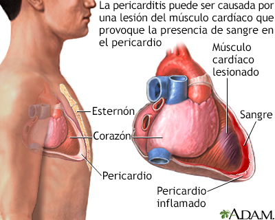 Pericarditis post-IM