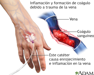 Tromboflebitis superficial