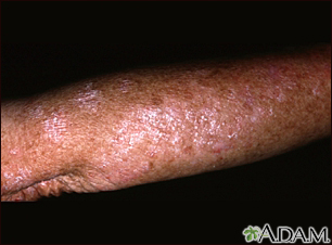 Queratosis actínica en el brazo