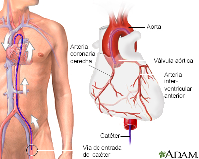 Angiografía coronaria