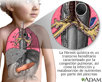 Fibrosis quística