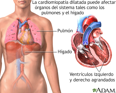 Cardiomiopatía dilatada