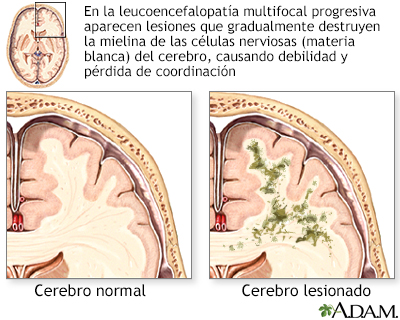 Leucoencefalopatía