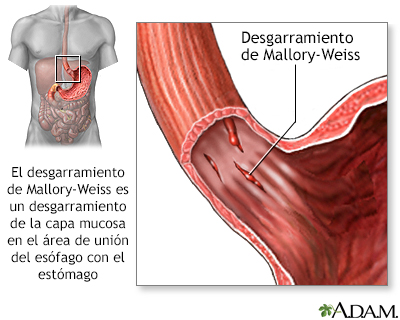 Desgarro Mallory-Weiss