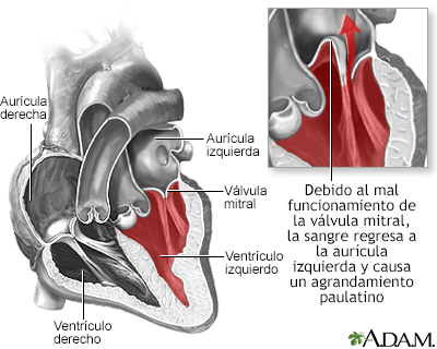 Prolapso de la válvula mitral