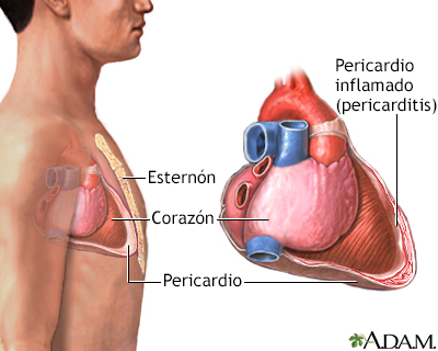 Pericarditis