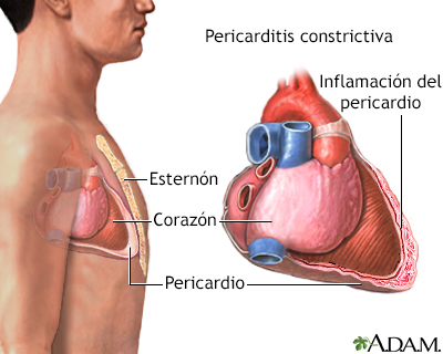 Pericarditis constrictiva