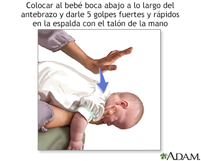 Maniobra de Heimlich en bebés