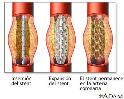 Procedimiento (cuarta parte)