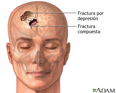 Fractura de cráneo