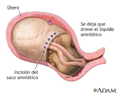 Procedimiento (cuarta parte)