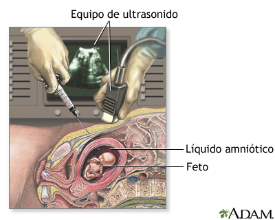 Amniocentesis