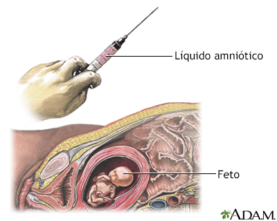 Amniocentesis