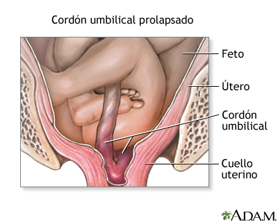 Prolapso del cordón umbilical