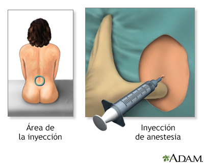 Procedimiento - Epidural 3