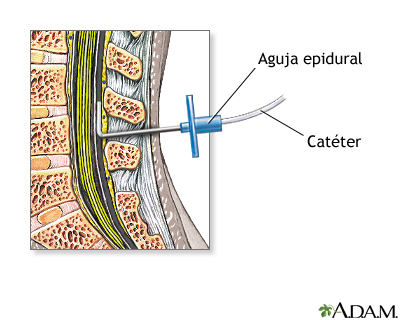 Procedimiento - Epidural 4