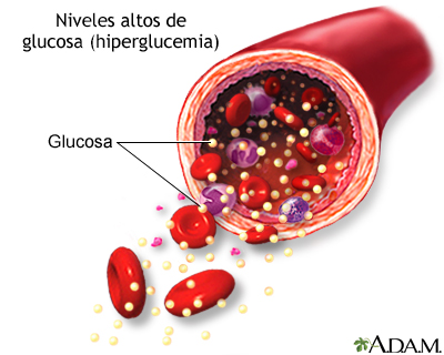 Nivel alto de azúcar en sangre