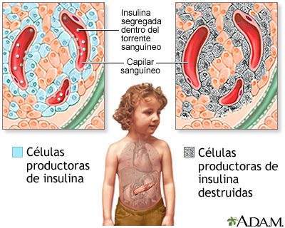 Diabetes tipo I