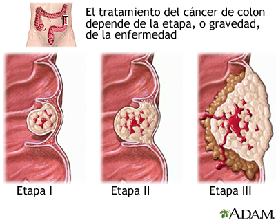 Etapas del cáncer