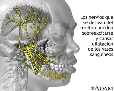 Causas de la migraña