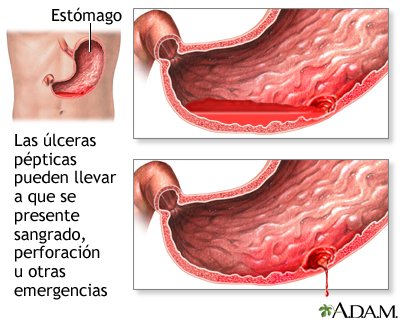 Emergencias por úlceras