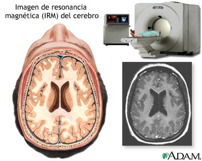 IRM del cerebro