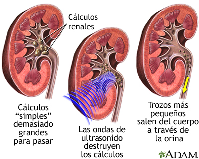 Litotripsia