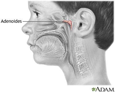 Adenoides