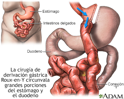 Cirugía gástrica en Y de Roux para perder peso