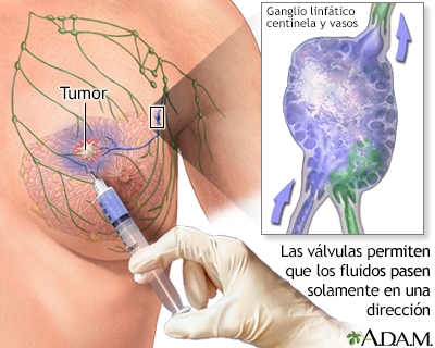 Biopsia de los ganglios centinelas