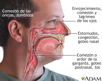 Síntomas de las alergias