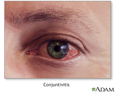 Conjuntivitis