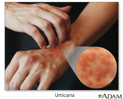 Urticaria