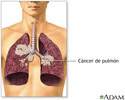 Humo de segunda mano y cáncer de pulmón