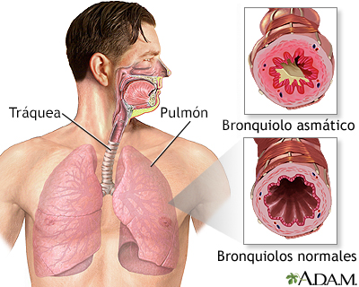 Bronquiolo asmático y bronquiolo normal