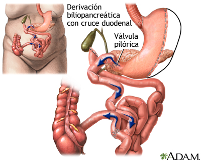 Derivación biliopancreática con cruce duodenal