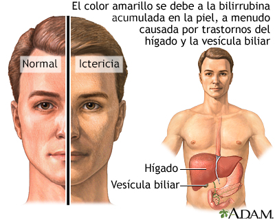 Ictericia