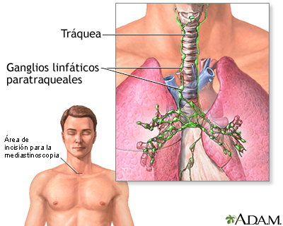 Mediastinoscopia