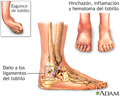 Esguince de tobillo