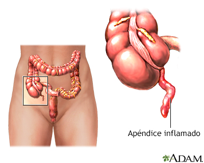 Apendicitis