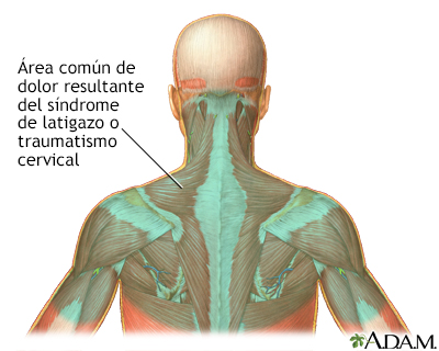 Localización del dolor por latigazo