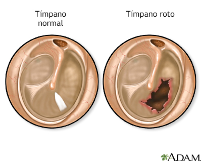 Tímpano roto